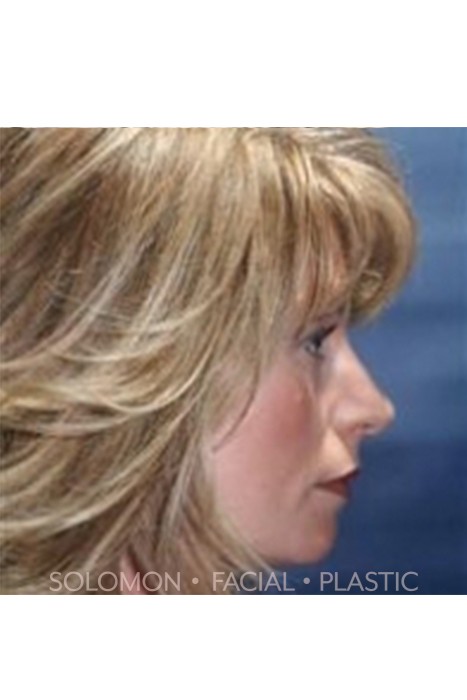 Revision Rhinoplasty Toronto Before After Photos