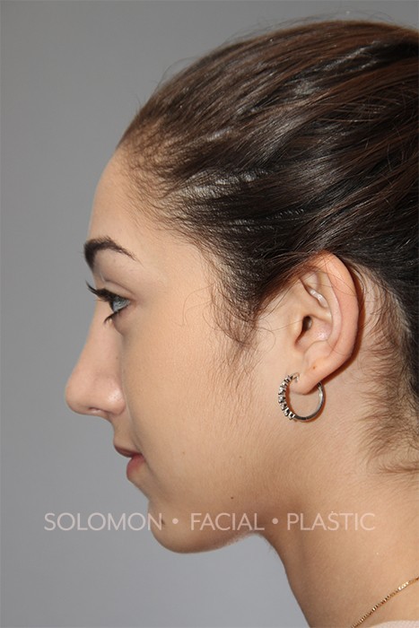 Rhinoplasty Surgery Before After Photos