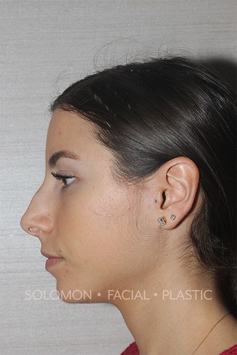 Rhinoplasty Surgery Before After Photos