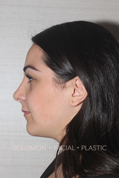 Rhinoplasty Surgery Before After Photos