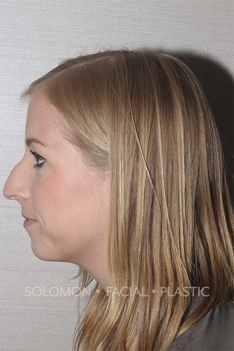 Rhinoplasty Surgery Before After Photos