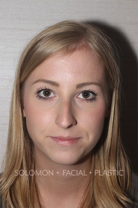 Rhinoplasty Surgery Before After Photos