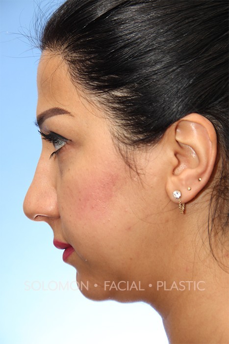 Rhinoplasty Surgery Before After Photos