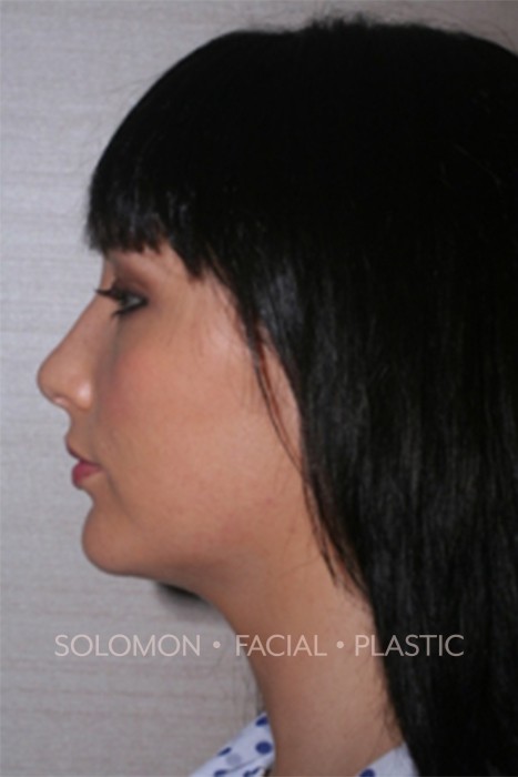 Rhinoplasty Toronto Before After Photos