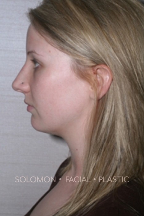 Rhinoplasty Toronto Before After Photos