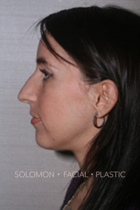 Rhinoplasty Toronto Before After Photos