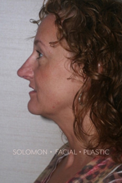 Rhinoplasty Toronto Before After Photos