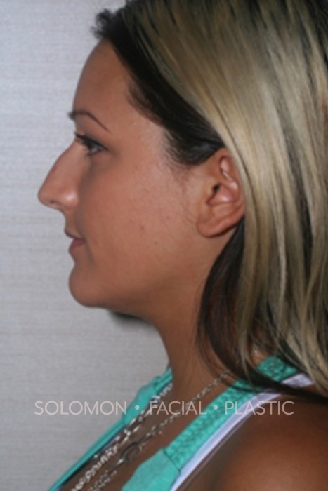 Rhinoplasty Toronto Before After Photos