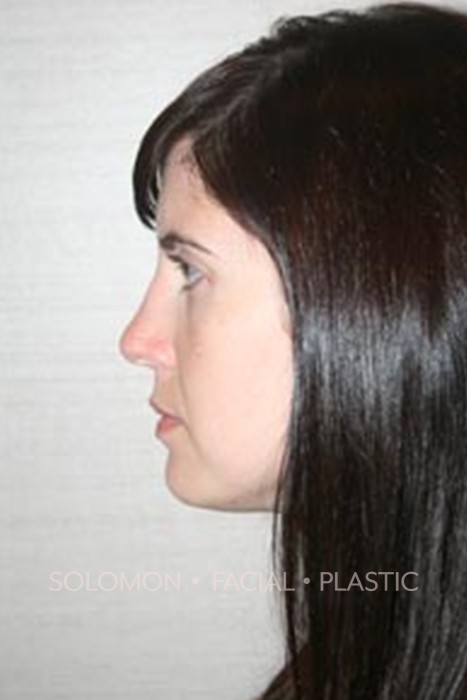 Rhinoplasty Toronto Before After Photos