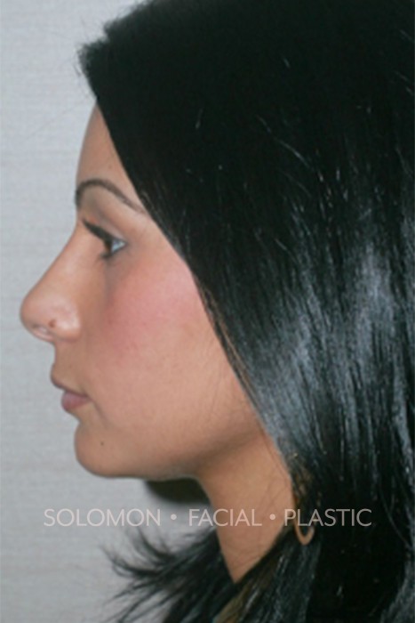 Rhinoplasty Toronto Before After Photos