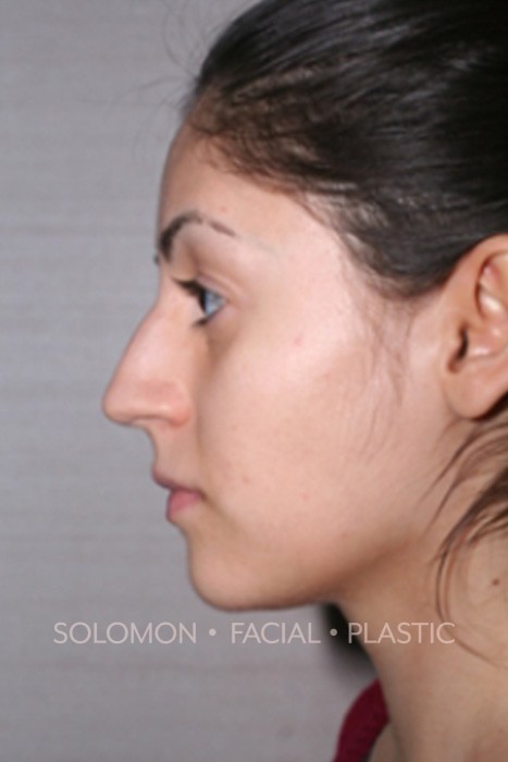 Rhinoplasty Surgery Before After Photos