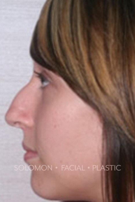 Rhinoplasty Surgery Before After Photos