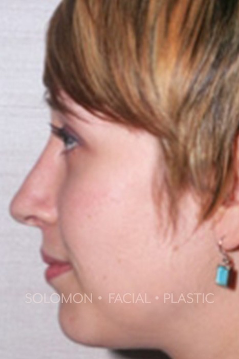 Rhinoplasty Surgery Before After Photos