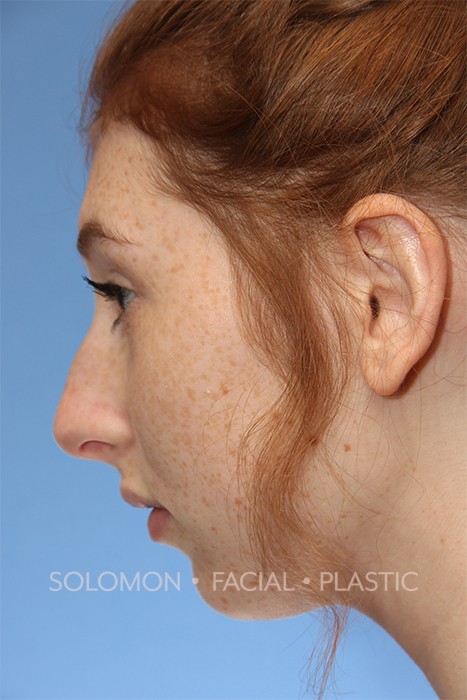 Rhinoplasty Surgery Before After Photos