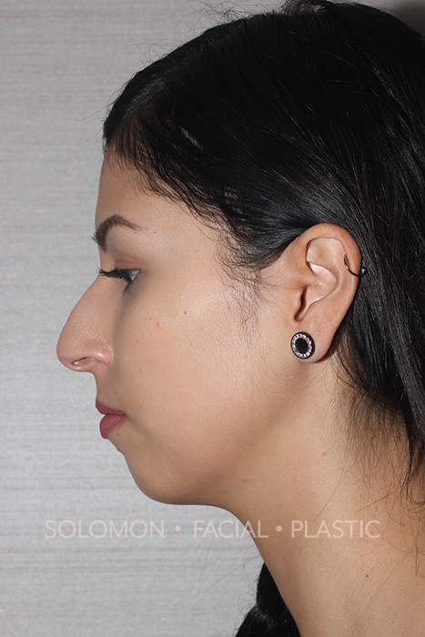 Rhinoplasty Surgery Before After Photos