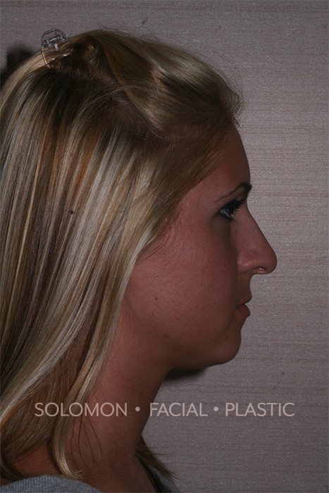 Nasal Tip Rhinoplasty Toronto Before After Photos