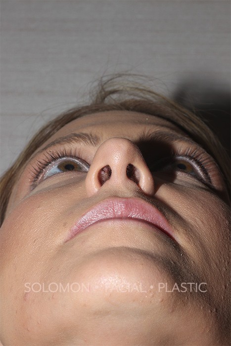 Nasal Tip Rhinoplasty Toronto Before After Photos