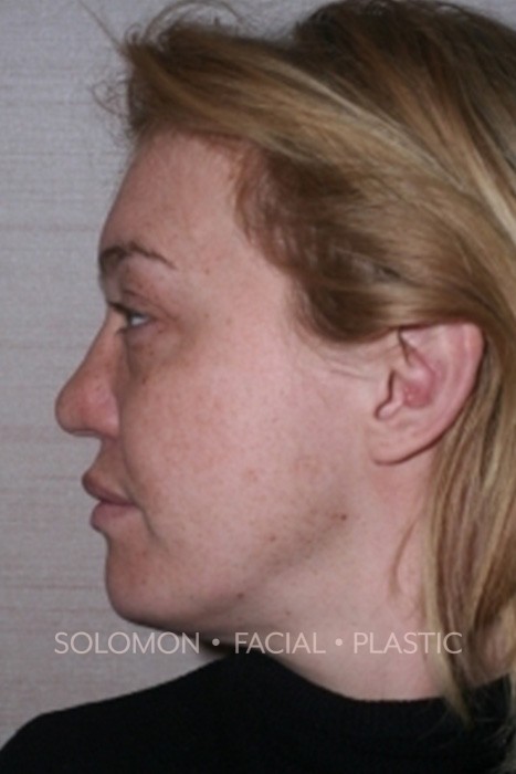 Nasal Tip Rhinoplasty Toronto Before After Photos