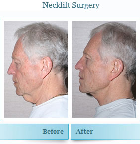 necklift-facelift