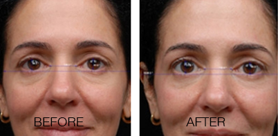 pelleve skin tightening near me