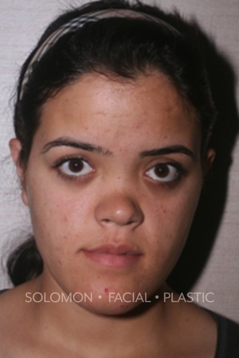 Reconstructive Septorhinoplasty Before After Photos