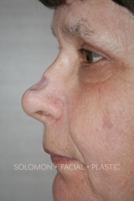 Reconstructive Septorhinoplasty Before After Photos