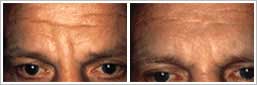 Facial Injectables Facial Injectables