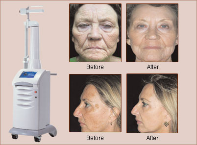 Lumenis UltraPulse® CO2 Fractional Laser Skin Resurfacing Natick