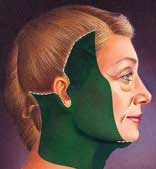 Face Lift Face Lift