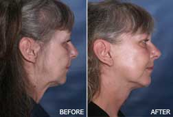 Face Lift : Before vs After Face Lift : Before vs After