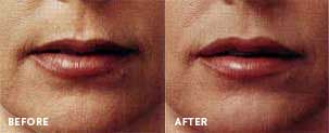 Lips Enlargement Lips Enlargement
