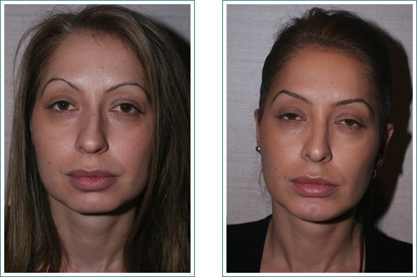 Buccal Fat Extraction Before and After