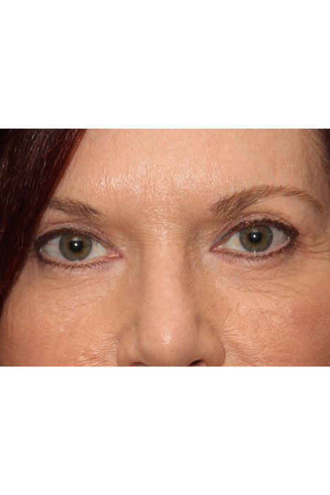 Blepharoplasty Before After Photos