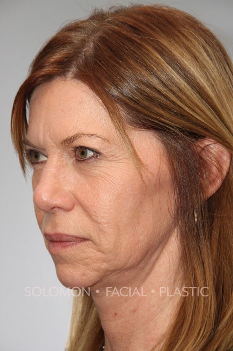 Facelift Before After Photos