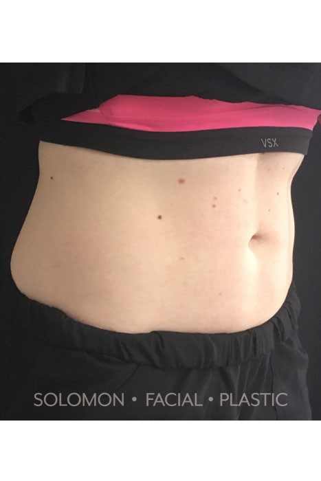 Cool Sculpting Before After Photos