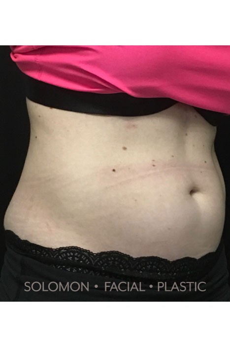 Cool Sculpting Before After Photos