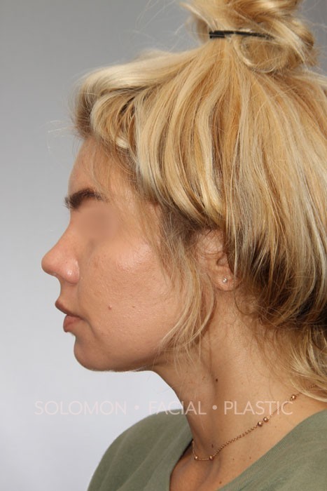 Neck Liposuction Before and After Photos