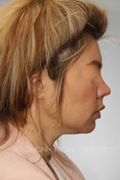 Neck Liposuction Before and After Photos
