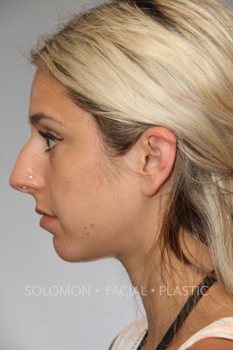 Rhinoplasty Surgery Before After Photos