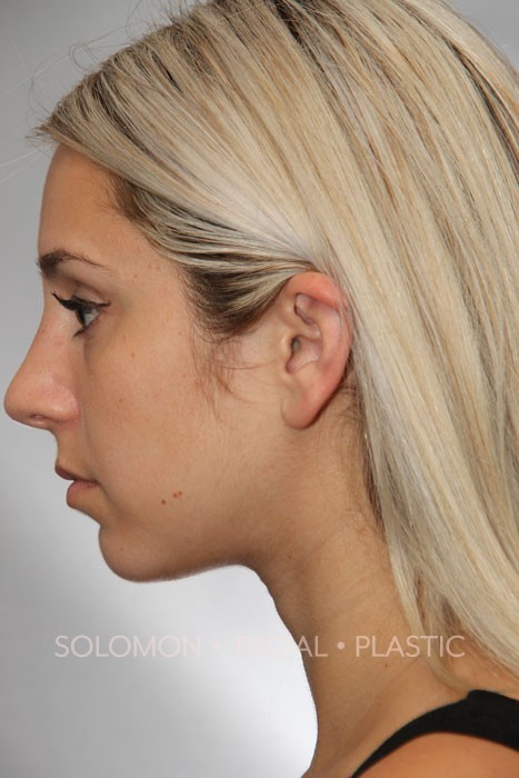 Rhinoplasty Surgery Before After Photos