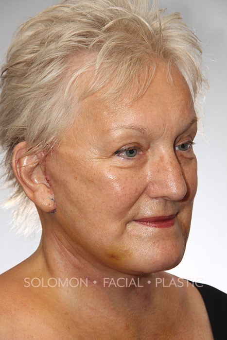 Facelift Before After Photos