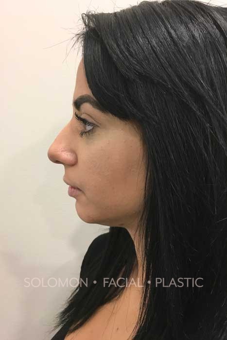 Rhinoplasty Surgery Before After Photos