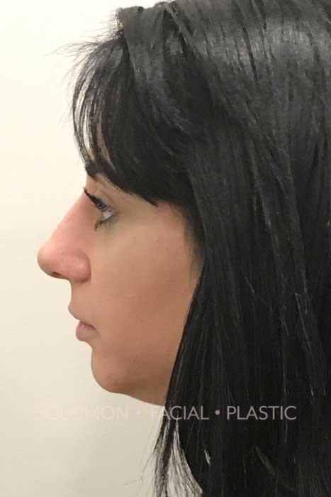 Rhinoplasty Surgery Before After Photos