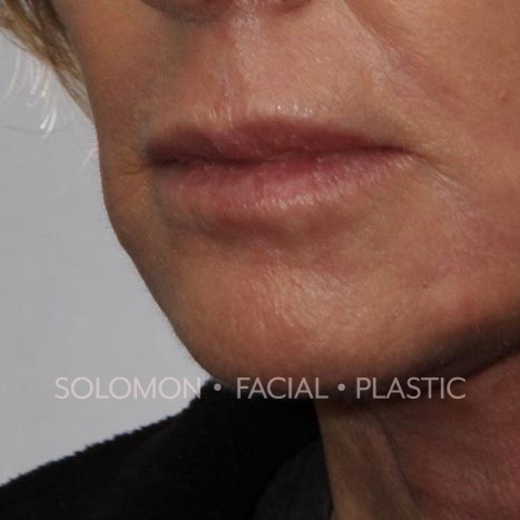 CO2 Laser Resurfacing before & after photos