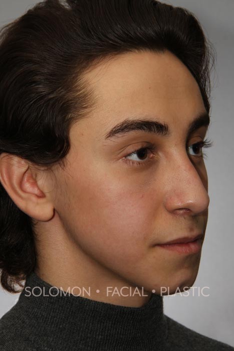 Rhinoplasty-before-after-photos