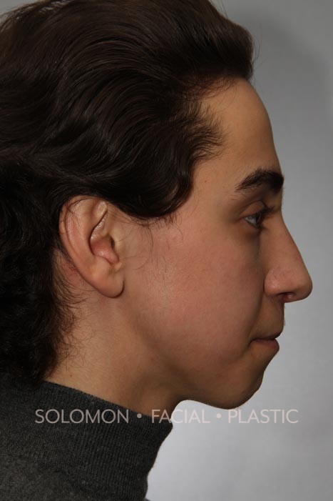 Rhinoplasty-before-after-photos