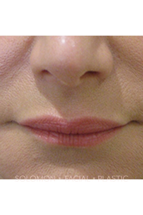 Facial Fillers Before After Photos