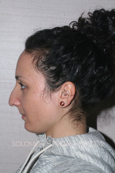 Rhinoplasty Surgery Before After Photos