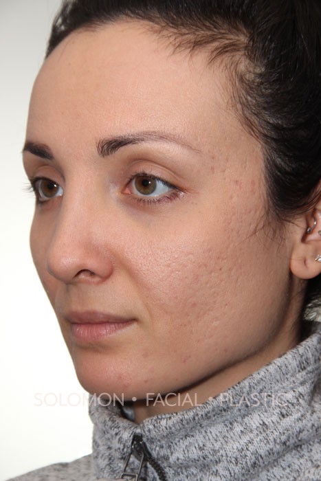 Rhinoplasty Surgery Before After Photos