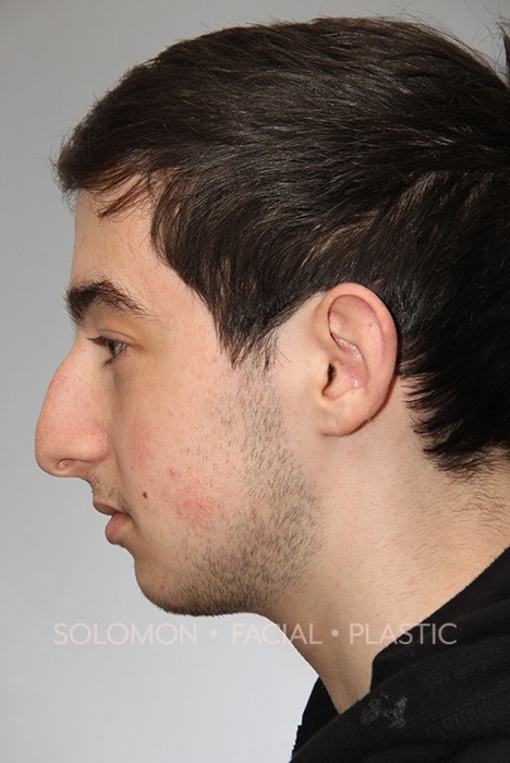 Rhinoplasty Surgery Before After Photos